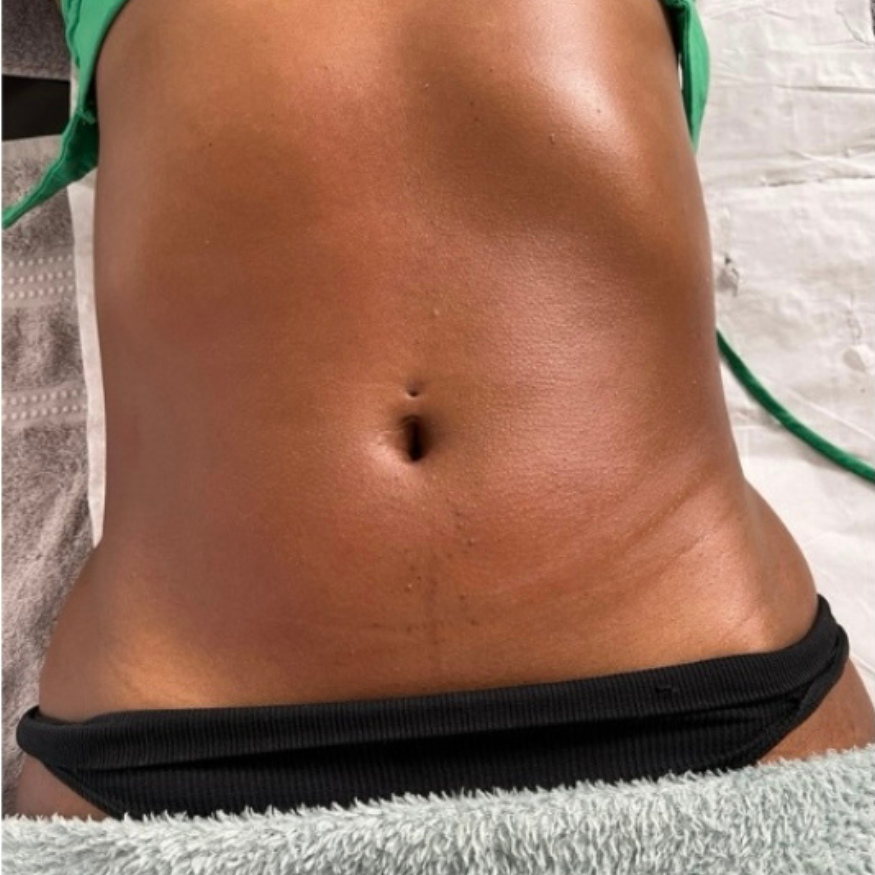 Lipocavitation